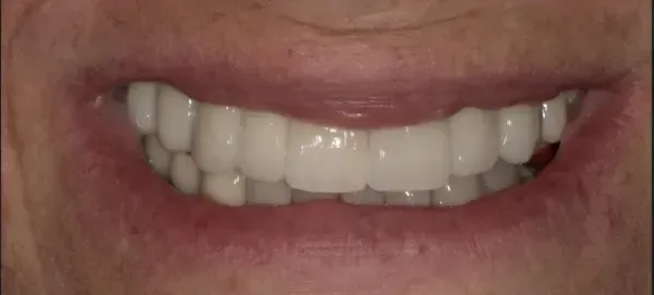 After smile transformation - patient 1