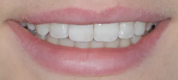 After smile transformation - patient 2