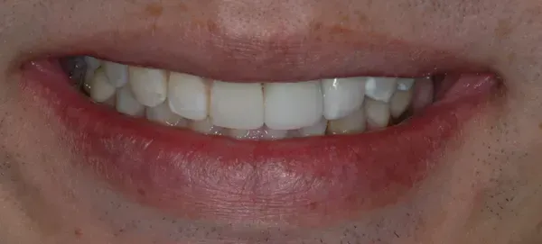After smile transformation - patient 3