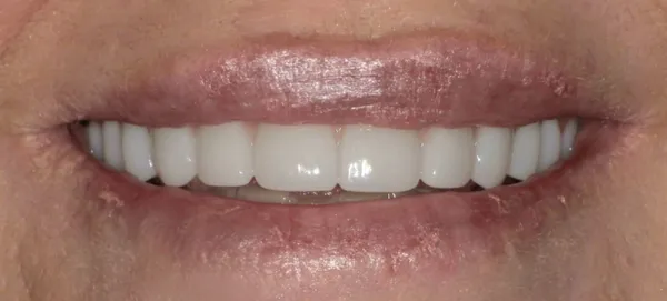After smile transformation - patient 4