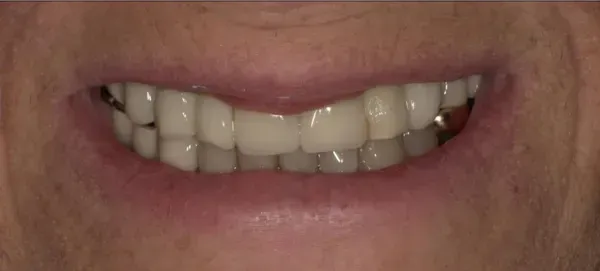 Before smile transformation - patient 1