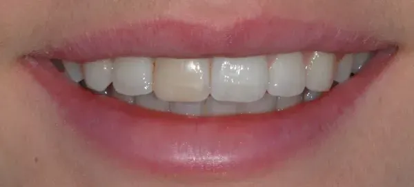 Before smile transformation - patient 2