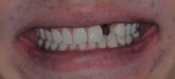 Before smile transformation - patient 3