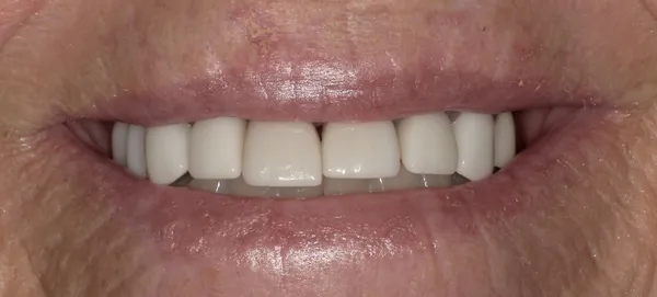 Before smile transformation - patient 4