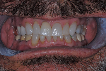 Before photo for veneers