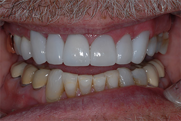 after photo for veneers