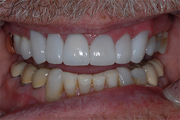 Before photo for veneers