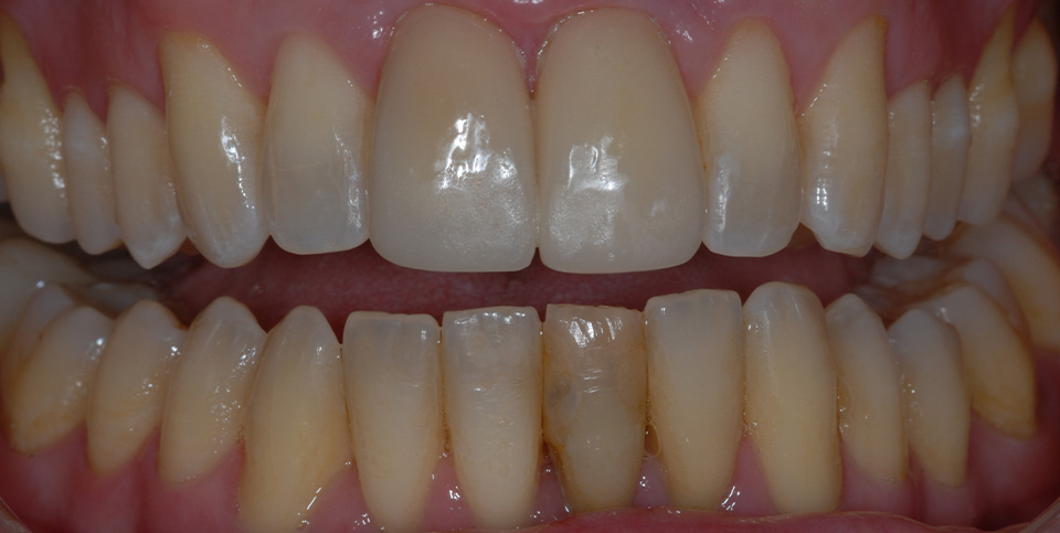 after photo for veneers