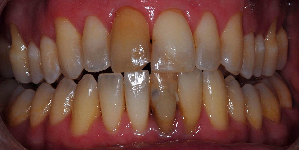 Before photo for veneers