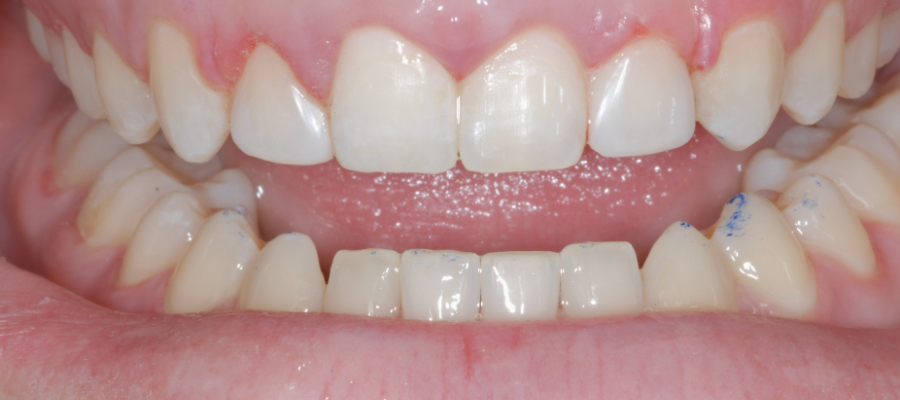 after photo for veneers