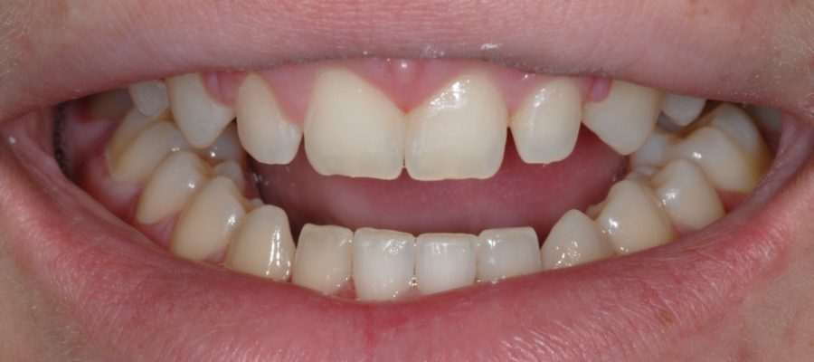 Before photo for veneers